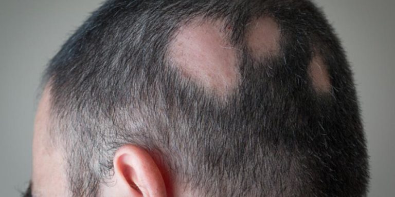 Recuperar el Cabello: Aprueban la primer pastilla para combatir la alopecia y así funciona Recuperar el Cabello: Aprueban la primer pastilla para combatir la alopecia y así funciona